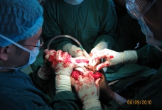 我院成功开展人工全膝关节置换手术